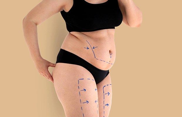 Liposuction or tummy tuck? How to tell the difference