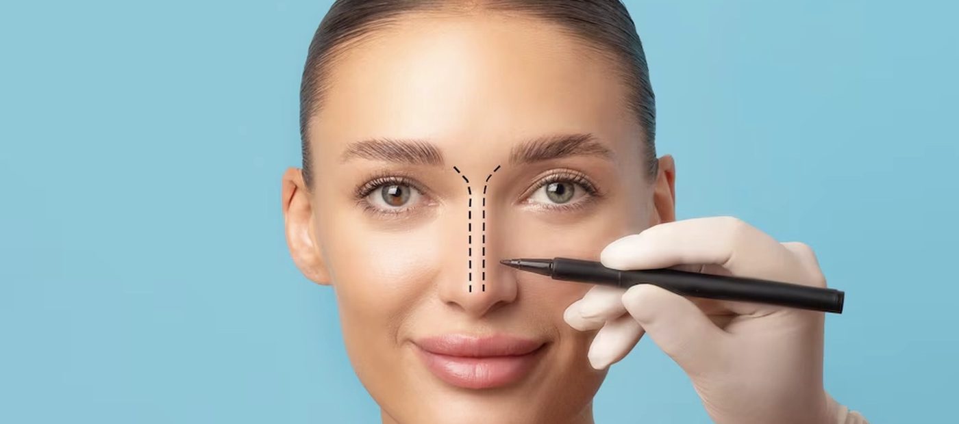 Rhinoplasty, pre-operative planning and marking
