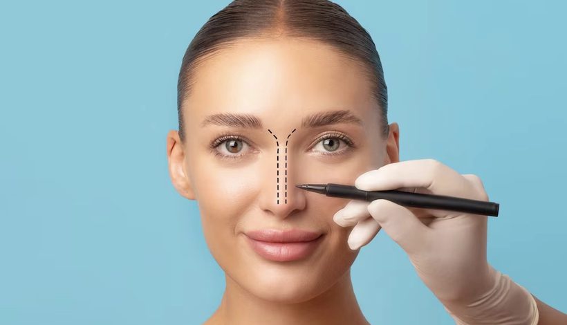 Nasenkorrektur (Rhinoplastik), präoperative Planung und Anzeichnung