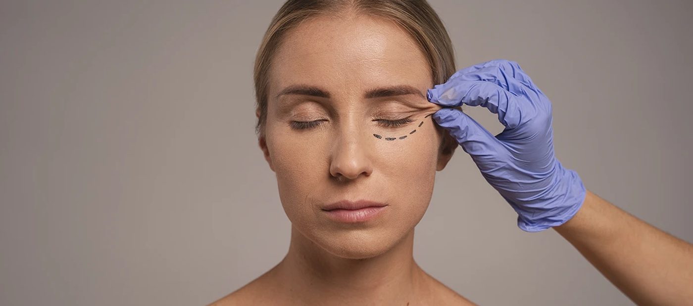 Eyelid Surgery (Blepharoplasty), pre-operative planning and marking