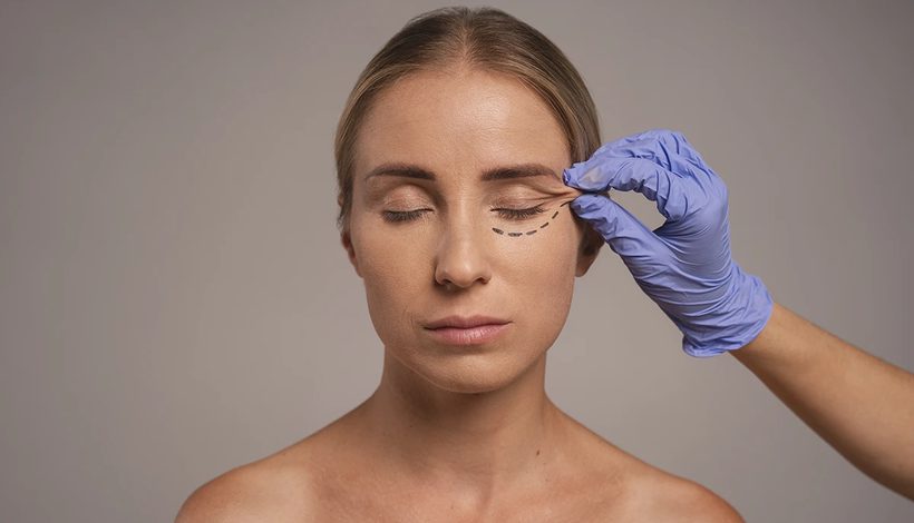 Lidstraffung (Blepharoplastik), präoperative Planung und Anzeichnung