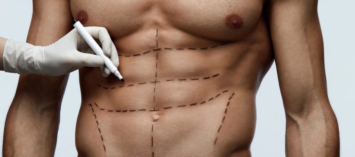 J-Plasma (Renuvion), pre-operative planning and marking