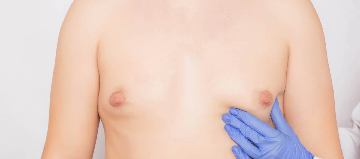 Gynecomastia, pre-operative planning and marking