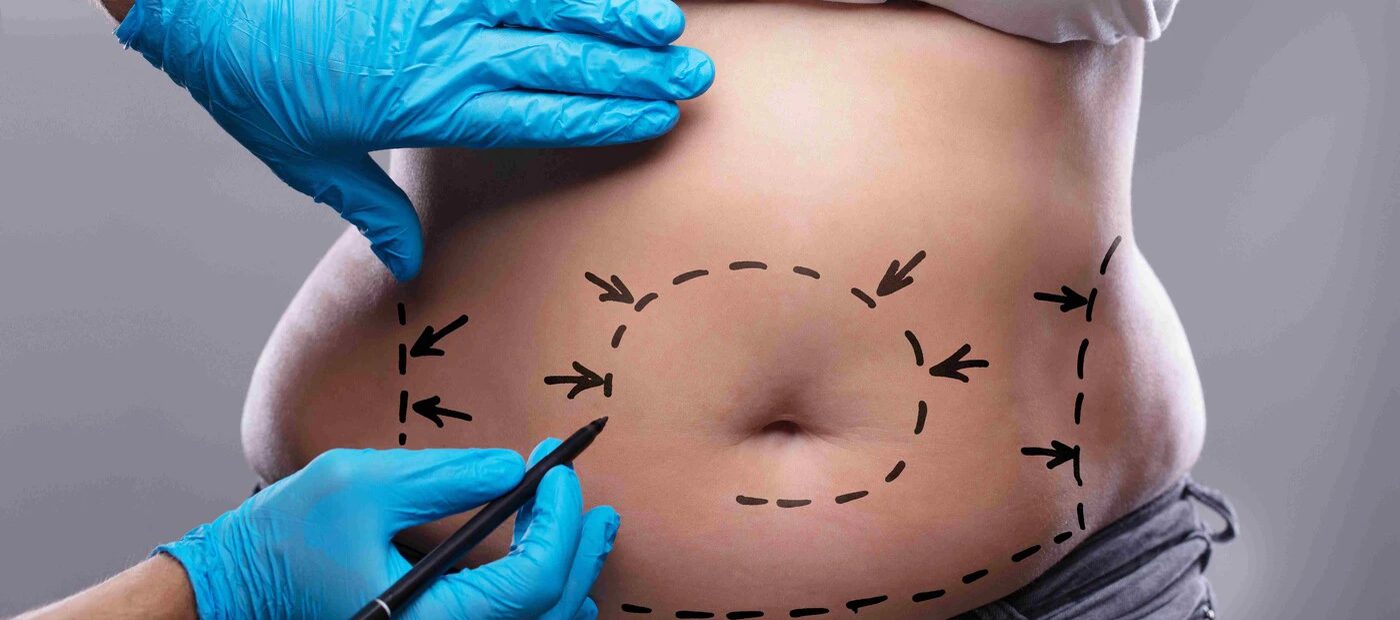 Tummy Tuck (Abdominoplasty), pre-operative planning and marking