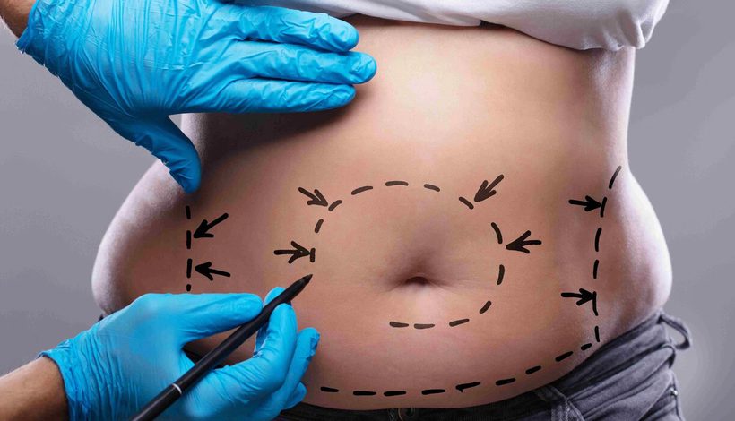 Bauchdeckenstraffung (Abdominoplastik), präoperative Planung und Anzeichnung