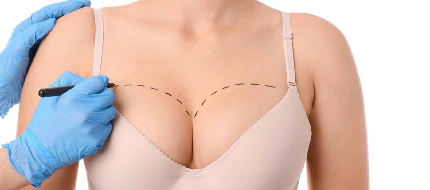 Breast Augmentation, pre-operative planning and marking