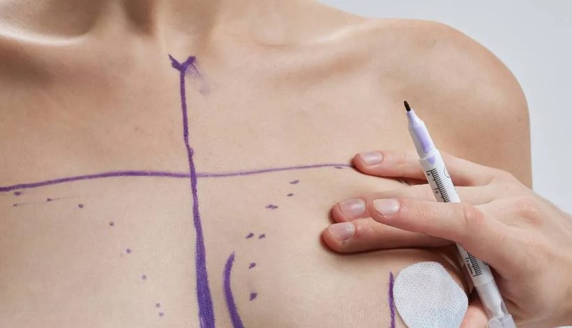 Bruststraffung, präoperative Planung und Anzeichnung