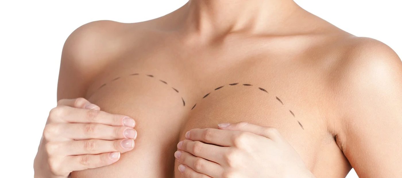 Breast Reduction, pre-operative planning and marking