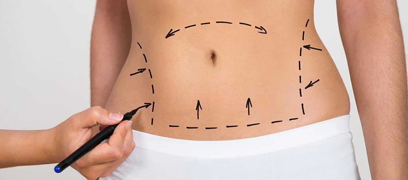 Vaser Liposuction, pre-operative planning and marking